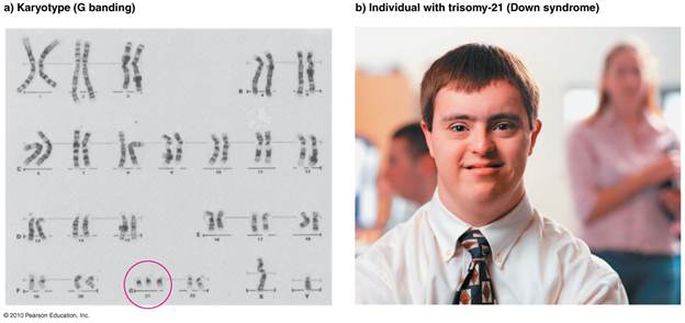 Down Syndrome is caused by the extra Chromosome at 21. Trisomy 21