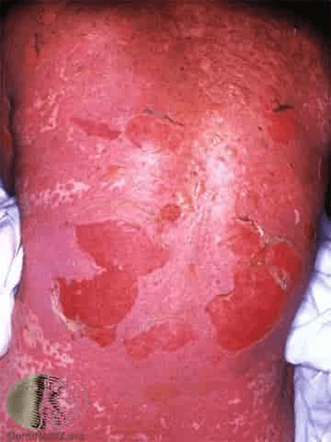 Toxic Epidermal Necrolysis (T.E.N.)