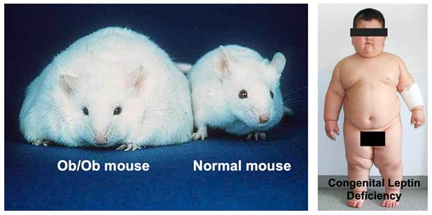 Giving leptin to human beings with congenital leptin deficiency rapid corrects obesity and appetite.