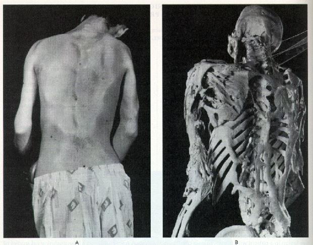 Fibrodysplasia Ossificans Progressiva