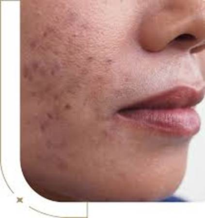 Hyperpigmentation