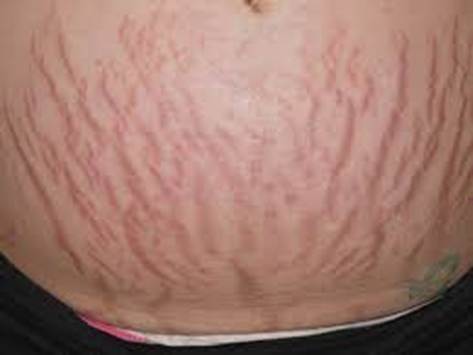 Striae, stretch marks