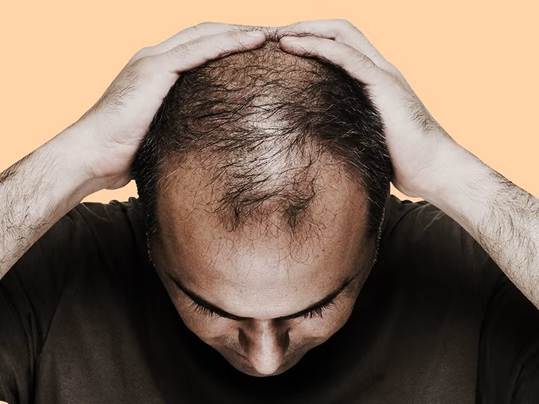 Hair loss, male pattern baldness