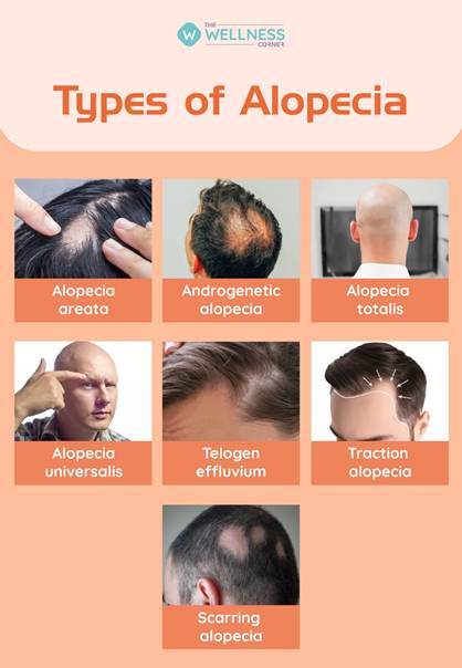 Types of Alopecia