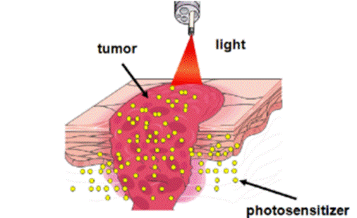 Photodynamic Therapy (PDT)
