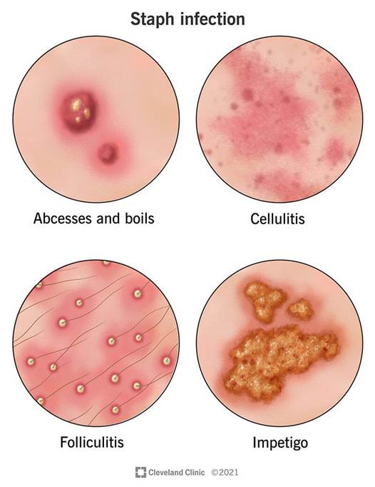 Skin infection types