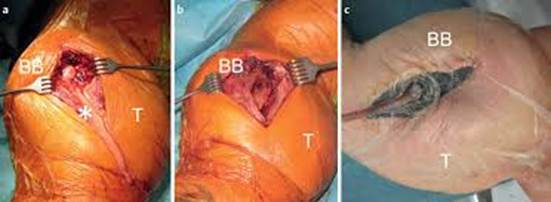 Necrotic Muscle from Synthol injections