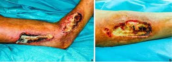 Necrotizing Fasciitis