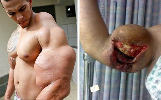 Prelude to Amputation.  Synthol.