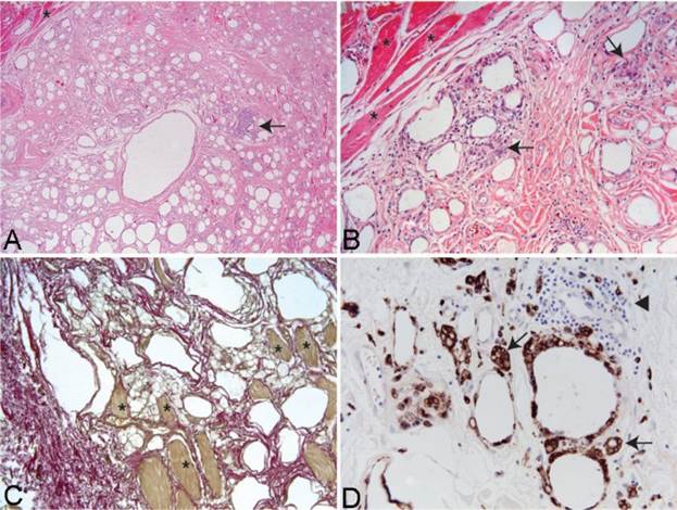 Microscopy of tissue sections of muscle injected with Synthol causing chronic pain