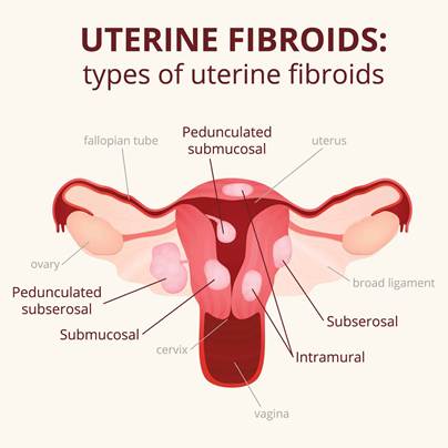 Fibroids, Types