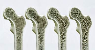 Osteoporosis in stages