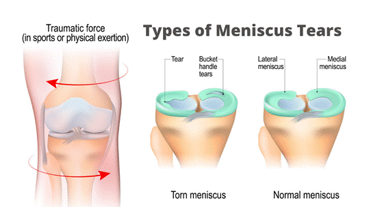 Types of Meniscal Tears