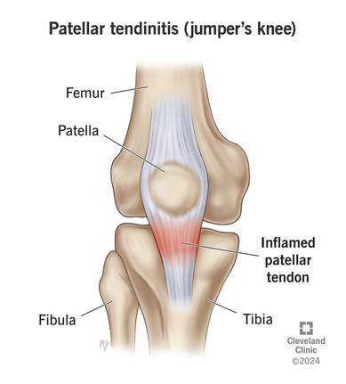 Patellar Tendinopathy/ Patellar Tendinitis as seen in Ballet dancers