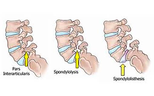 Spondylolysis in ballet dancers may be associated with Spondylolisthesis