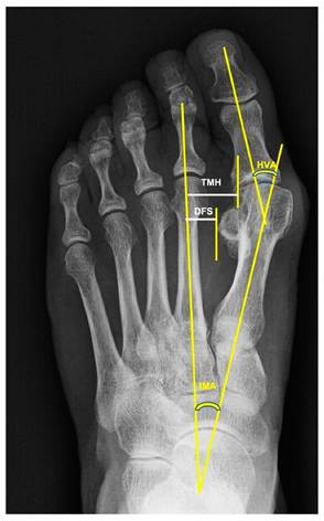 Hallux Valgus and bunion deformity in Ballet dancers