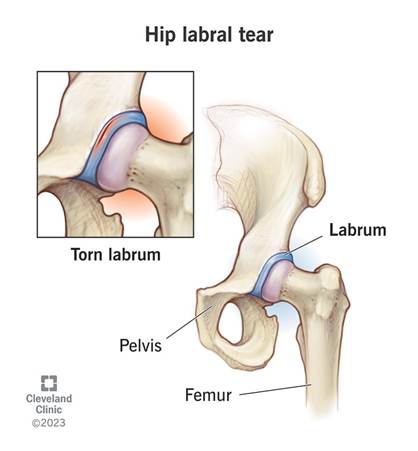 Hip Labral Tears are common in Ballet Dancers
