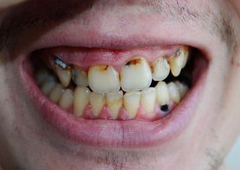 Why Suboxone Wrecks Teeth: A Biochemist’s Warning for Pain&nbsp;Patients